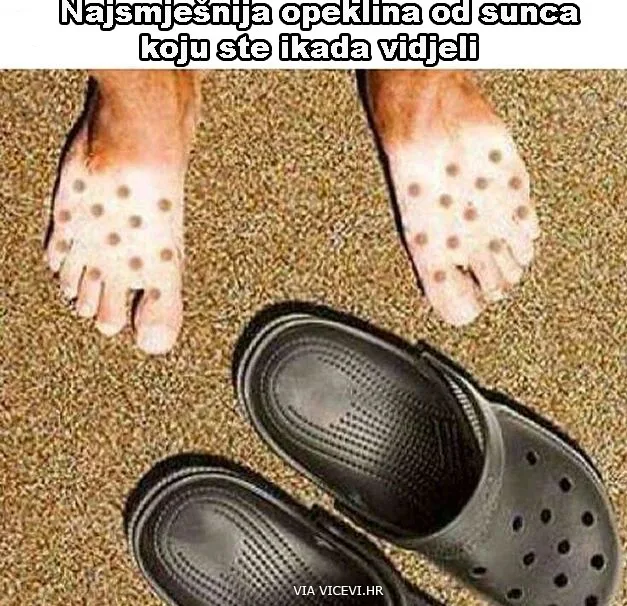 Najsmješnija opeklina od sunca ikada